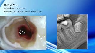 Endodoncia Molar Inferior Clinica Dental Velez [upl. by Annaerdna]