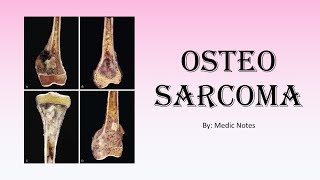 Ortho Osteosarcomabone cancer  causes xray findings signs amp symptoms treatment [upl. by Nuoras163]