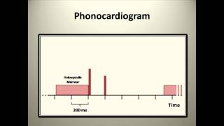 Heart Murmur Example 1 Explained [upl. by Lehrer]