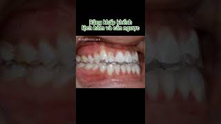 Braces croked teeth overbite braces orthodontist niengrang nhakhoa [upl. by Trumann]