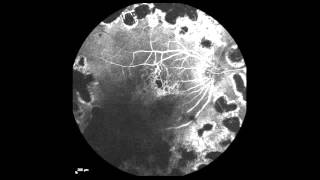 RealTime Fluorescein Angiography [upl. by Gerianna649]