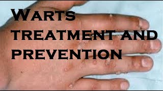 Warts treatment and prevention [upl. by Aggy]