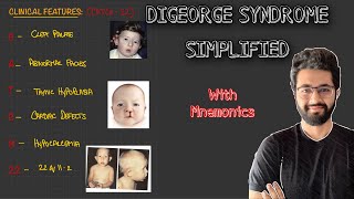 Digeorge Syndrome  Etiopathogenesis Clinical FeaturesDiagnosis and Management [upl. by Narih]