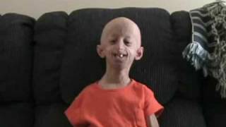 Progeria  An unneeded suffering without a cause [upl. by Rosina393]