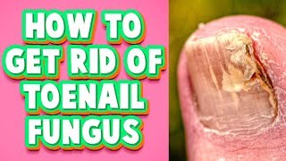 Toenail Fungus Treatment at Home A Fast Cure You Must Try [upl. by Eradis]