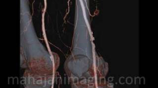 Lower Limb CT Angiography [upl. by Player]