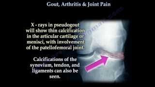 Gout Arthritis amp Joint Pain  Everything You Need To Know Dr Nabil Ebraheim [upl. by Gerrard436]