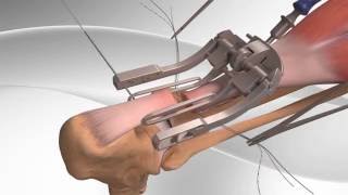 Achilles Tendon Rupture Repair with Arthrex® PARS System [upl. by Vel]