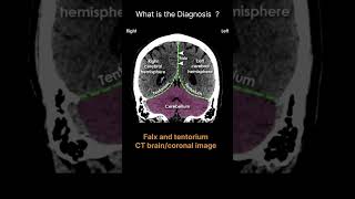 Falx and tentorium CT braincoronal image CT Brain Anatomy Meninges Quiz 14radiologychannel007 [upl. by Hilde408]