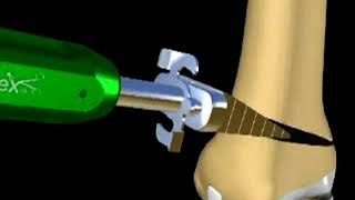 Distal Femoral Osteotomy to correct a valgus knee [upl. by Carmina756]