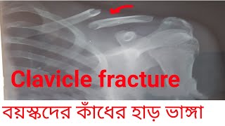 Adult Clavicle fracture conservative Treatment and rehabilitation [upl. by Yar]