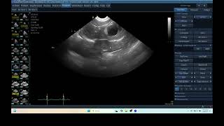 IQ 271 TFAST MEDIASTINAL LYMPHOID NODE ENLARGEMENT ECHOPAC ANALYSIS ULTRASOUND [upl. by Necila]