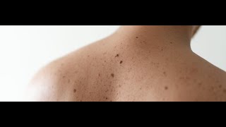 Birthmarks Symptoms and Causes  Diagnosis  Treatment  Prevention [upl. by Joey]