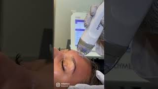 RF Microneedling Face Treatment shorts viral trending skincare [upl. by Lenroc]