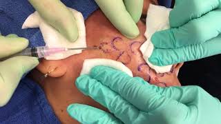 Subcision at Sanova Dermatology [upl. by Nomla542]