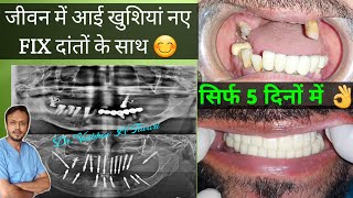 Full Mouth Dental Implant from Start to End [upl. by Solakcin333]