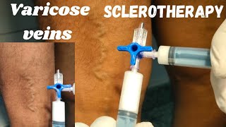 Foam Sclerotherapy Treatment of varicose vein Sclerotherapy of varicose veins Varicose veins [upl. by Ariayek]