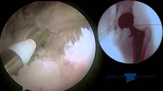 Hip Arthroscopy Total Hip Replacement  Iliopsoas Tendon Release for Impingement on a Collared Stem [upl. by Wendt]