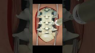 Discectomy of lumber medicalstudent operationsresearch doctors backbone supine patient [upl. by Sigismondo855]