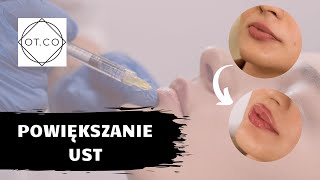 Powiększanie ust pytania i odpowiedzi z efektami przed i po  OTCO Clinic [upl. by Ecylahs]