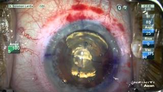 Catalys Laser Cataract Surgery vs Traditional Manual Cataract Surgery  Animation [upl. by Bushey]