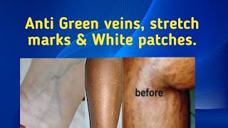 Anti Green veins Stretch marks amp White patches Your customers wouldnt complain again [upl. by Ahsinahs]