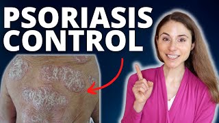 TOP 5 TIPS TO CONTROL PSORIASIS FLARES 😊 DERMATOLOGIST DrDrayzday [upl. by Trah]