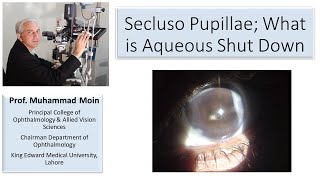 Occluso Pupillae What is Aqueous Shut Down [upl. by Llemej]