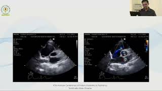 Approach to Congenital Cyanotic Heart Disease in neonatal period  Dr M Venkatesh [upl. by Ranjiv]