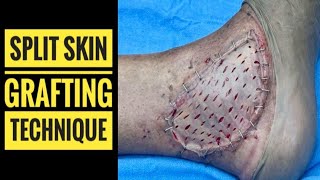 Split Thickness Skin Graft Technique [upl. by Hcra]