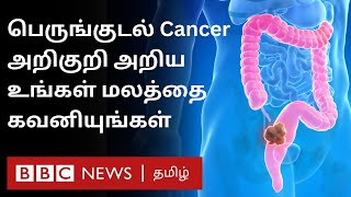 Cancer Disease பெருங்குடல் புற்றுநோயின் முதல் அறிகுறி என்ன எப்படி குணப்படுத்துவது [upl. by Ybeloc]