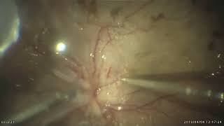 Part 2 Old retinal detachment with fascinating subretinal pathology [upl. by Yrogiarc86]