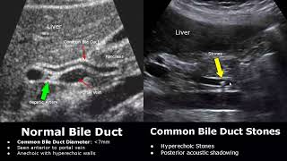 Bile Duct Ultrasound Normal Vs Abnormal Image Appearances  Biliary Tract Abnormalities USG Scan [upl. by Garrot]