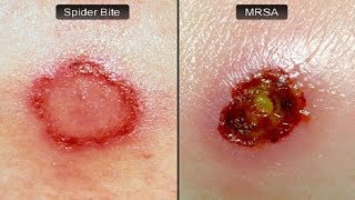 How To Get Rid Of A Staph Infection [upl. by Yvette125]