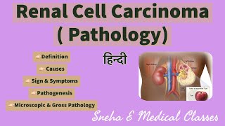 Renal Cell Carcinoma  Pathology  Hindi [upl. by Komara]