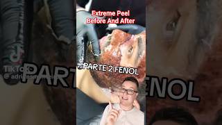 TW😱 SHOCKING CHEMICAL PEEL  Phenol Peel Before and After shorts [upl. by Namqul799]