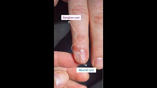 Ganglion cyst vs Myxoid cyst [upl. by Bella]