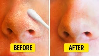 9 Natural Ways to Get Rid of Blackheads on Nose [upl. by Dralliw]