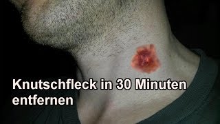 Knutschflecken mit Mundwasser in 30 Min entfernen  Knutschfleck schnell wegbekommen  Tutorial [upl. by Dianthe262]