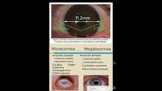 Normal Cornea VS Microcornea  Optometry Solutions [upl. by Moriyama]