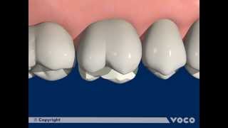 Universal adhesive Futurabond UPart 1112 Indirect restoration with a DCCC luting composite [upl. by Krug]