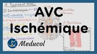 AVC ischémique causes embolie cérébrale AVC thrombose et AVC jonctionnel [upl. by Aimehs484]