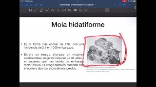 Mola hidatiforme [upl. by Ivy]