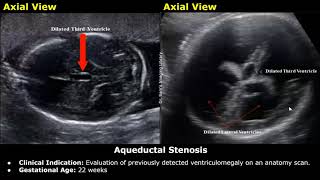 Fetal Brain Ultrasound Reporting  Obstetric Brain Pathologies Scan Reports  Pregnancy USG [upl. by Bank]