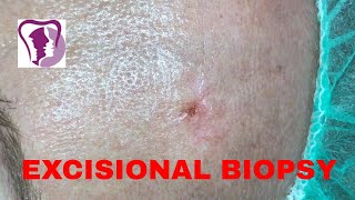 Excisonal Biopsy of lesion in the forehead  Dr Sunil Richardson [upl. by Atoiganap]