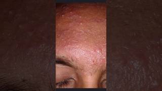 Clindamycin phosphate gel usp review viral shortsvideo acne pimpleproblem clindamycin [upl. by Verada]