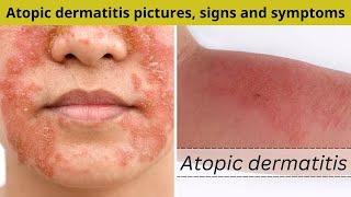 Atopic dermatitis pictures signs and symptoms  Nuse Healthy [upl. by Atinahc]