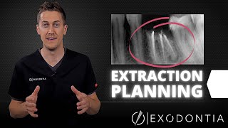 How To Extract Teeth Successfully Every Time  OnlineExodontiacom [upl. by Aydne]