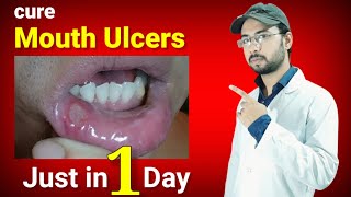 cure mouth ulcers just in one day permanently  mouth ulcer home remedy  canker sore home remedy [upl. by Stoddard]