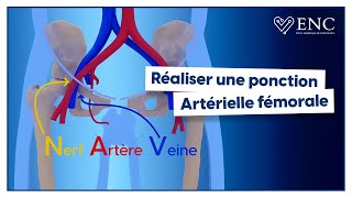 Comment ponctionner lartère fémorale [upl. by Larena]